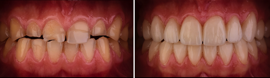 La gouttière dentaire au cœur de l'orthodontie fonctionnelle