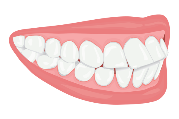 iSmile  Le protège-dents adulte