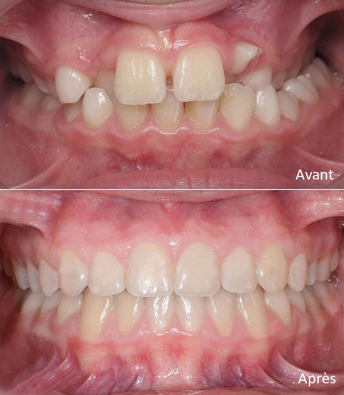 Invisalign diamond 1