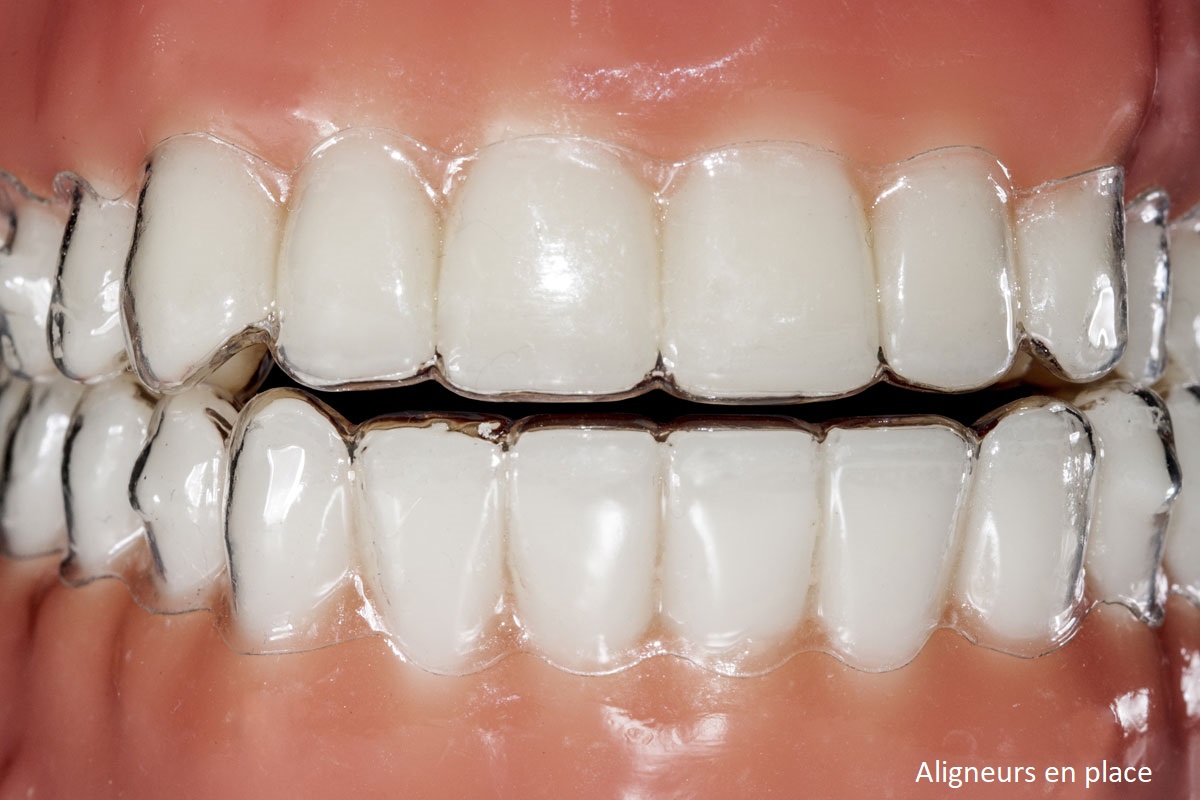 Invisalign diamond 1